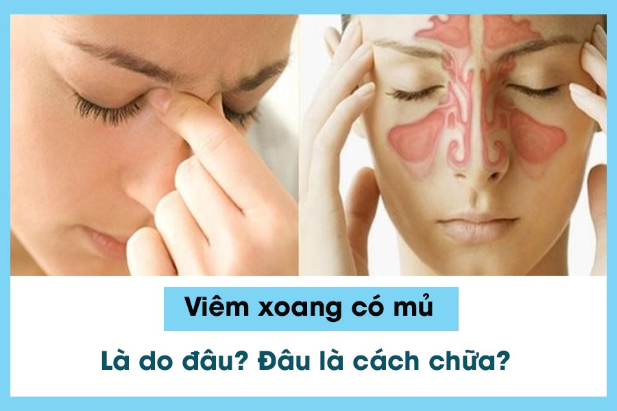 Dấu hiệu của viêm xoang